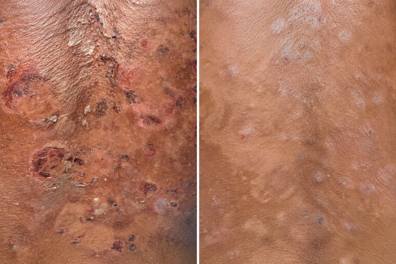 Before and after clinical clearance of facial DPN and skin tags