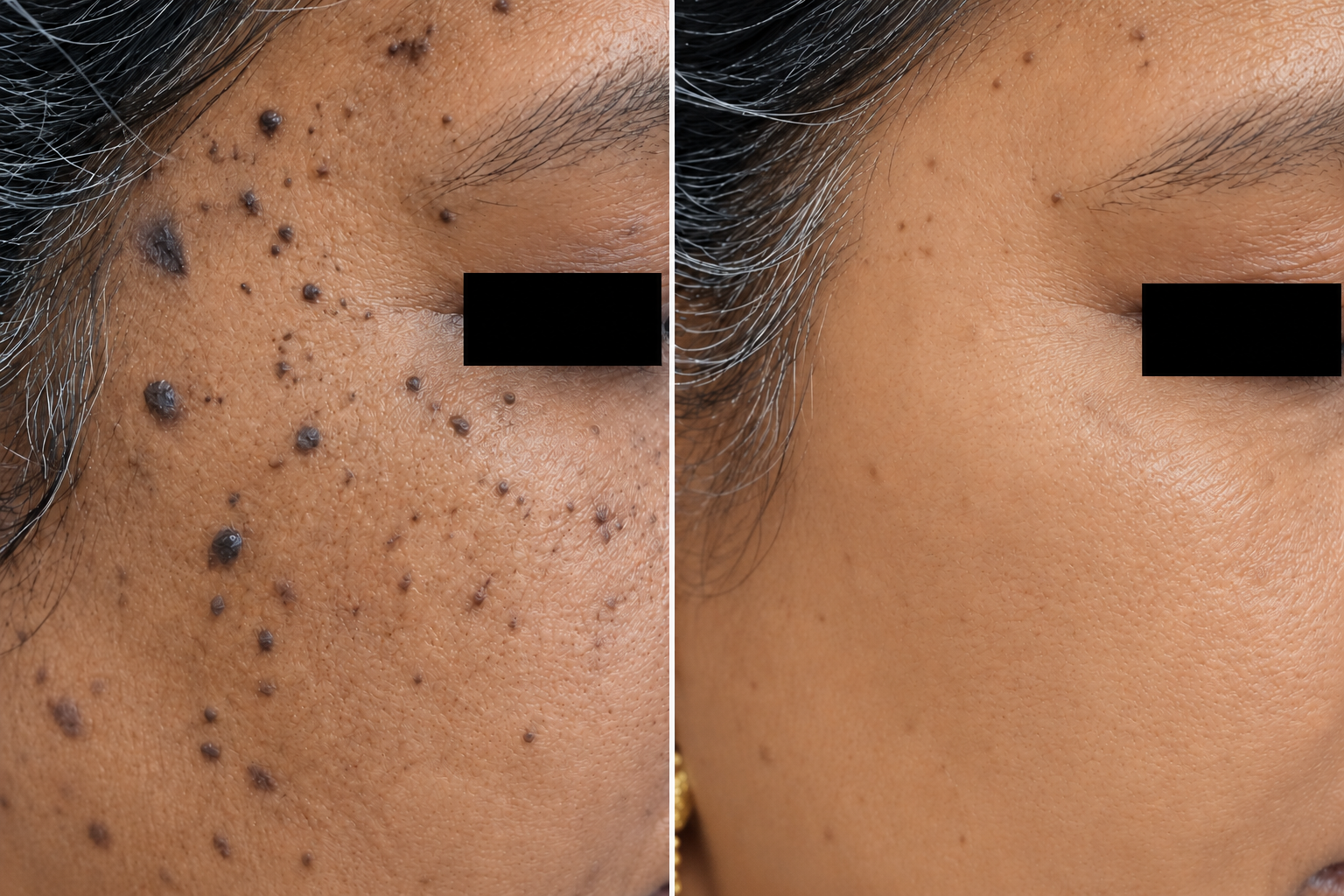 Before and after clinical clearance of facial DPN and skin tags