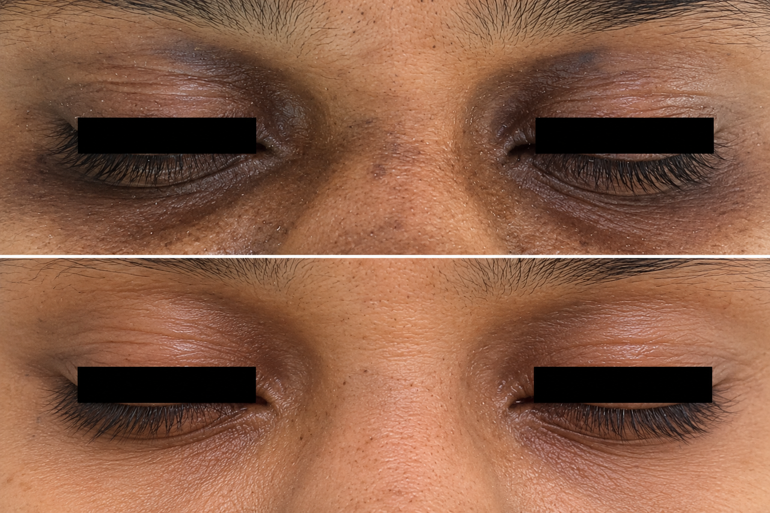 Before and after clinical results for under-eye dark circles and pigmentation clearance