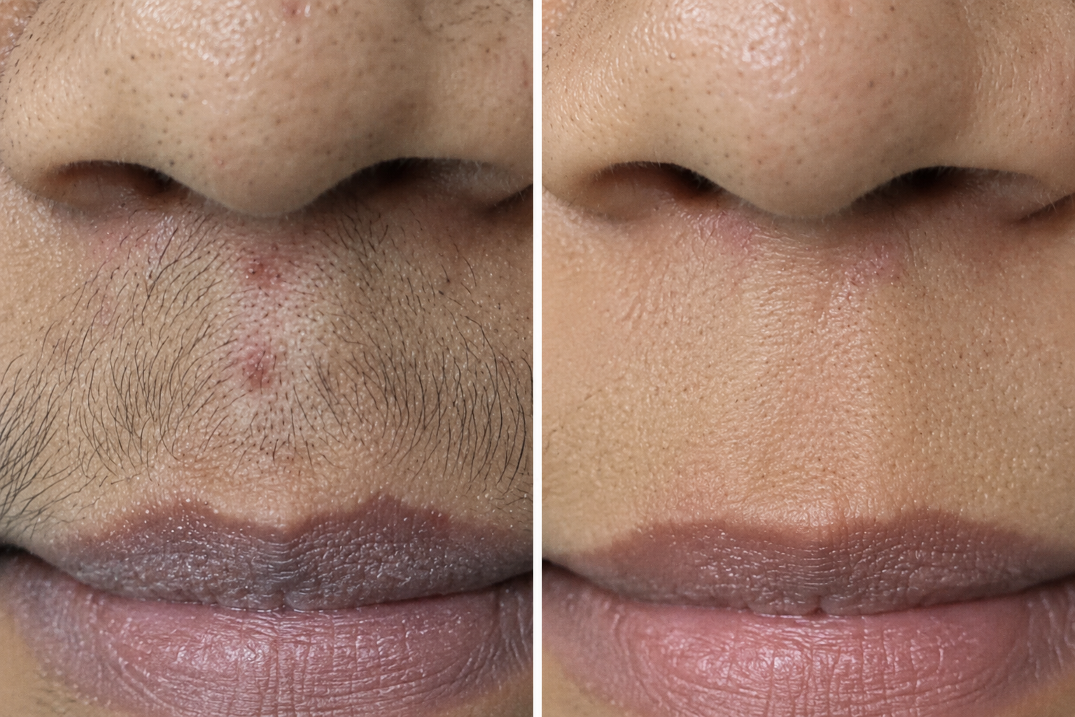 Before and after clinical laser hair reduction on upper lip