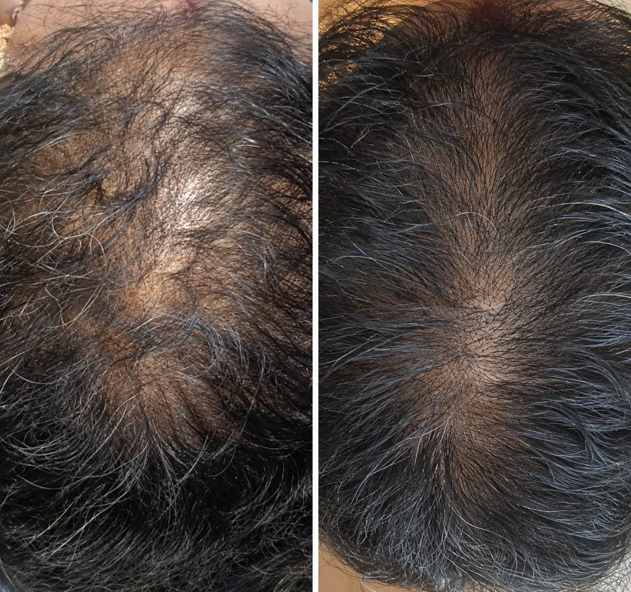 Before and after treatment for vertex and crown hair loss restoration