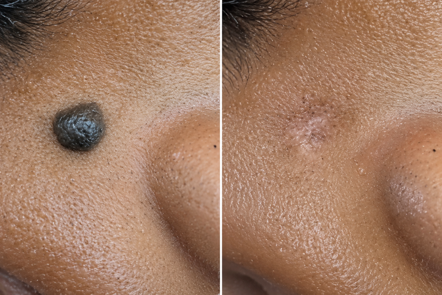 Before and after clinical radiofrequency facial mole removal